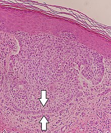 Palisading in nodular basal-cell carcinoma. Palisading in basal cell cancer.jpg
