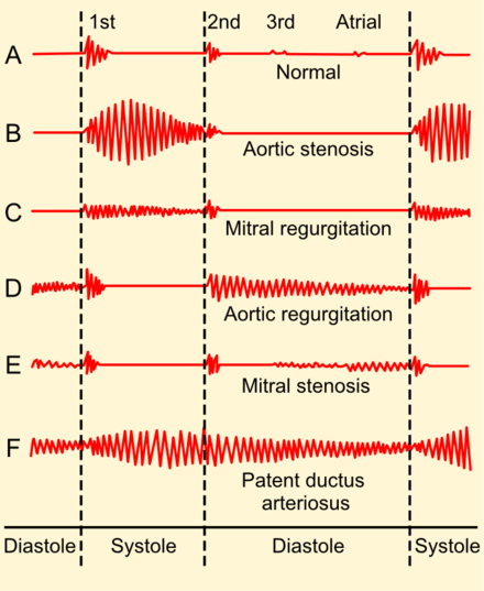 Phonocardiograms (also known as auscultograms) of common heart murmurs.