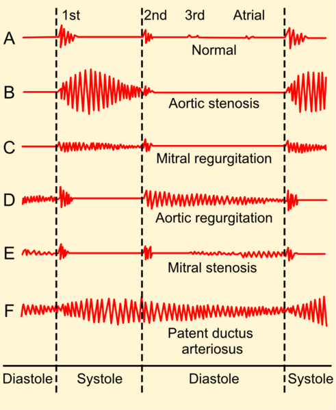 File:Phonocardiograms from normal and abnormal heart sounds.png