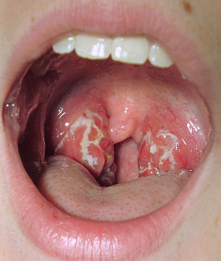 A set of large tonsils in the back of the throat covered in yellow exudate