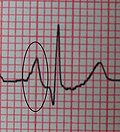 Thumbnail for Right atrial enlargement