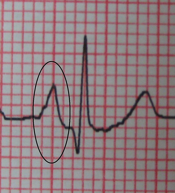 Увеличение правого. Зубец p pulmonale. Р-pulmonale на ЭКГ. Зубец р-pulmonale на ЭКГ. P pulmonale на ЭКГ.