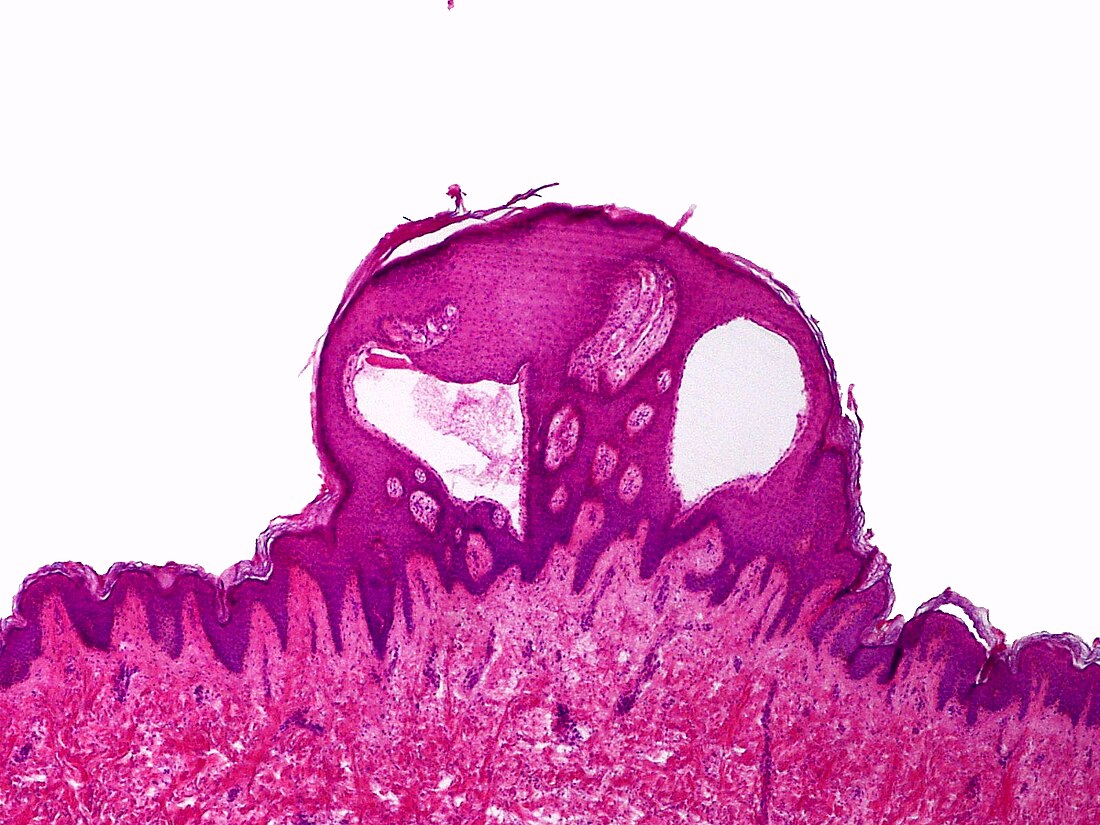 Lymphangioma circumscriptum