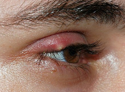 Eyelid affected by stye