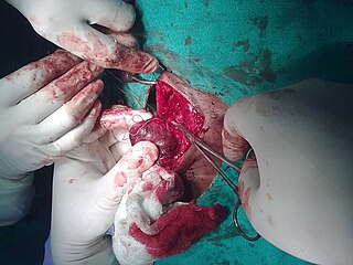 <span class="mw-page-title-main">Thyroidectomy</span> Surgical prodecure involving partial or complete removal of the thyroid
