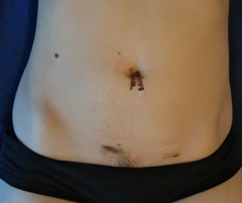 Wound healing - ten days after a laparoscopic appendectomy Appendectomy plus 10 days.png