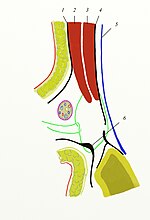 Bassini technique, first suture. 1. Aponeurosis musculi obliq. ext.; 2. Musculus obliquus internus; 3. Musculus transversalis; 4. Fascia transversalis; 5. Peritoneum; 6. Ligamentum inguinale. Bassini Operation. The first suture.jpg