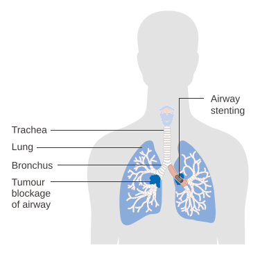 File:Diagram showing an airway stent CRUK 095.svg