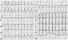 Flutter predsiení na EKG