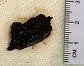 Melanoma