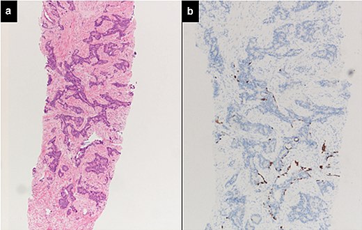 Intraductal carcinoma of the prostate with very patchy basal cells identified by immunohistochemistry. At least some of the glands lacking basal cell immunoreactivity represent intraductal rather than invasive carcinoma (a haematoxylin and eosin, b CK 5/6)[19]