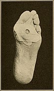 Category:Foot bandages - Wikimedia Commons