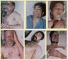 Victims of the 1987 chemical attack on Sardasht, West Azerbaijan, Iran Sardashtchemic.jpg