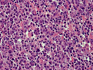 <span class="mw-page-title-main">Cutaneous B-cell lymphoma</span> Medical condition