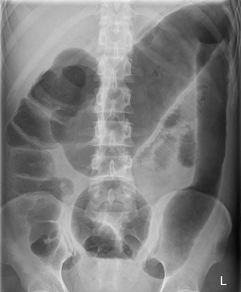 File:Toxic Megacolon in Ulcerative Colitis.jpg