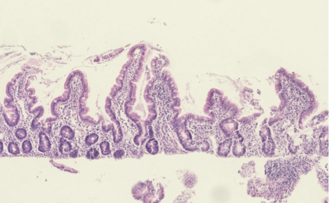 Environmental enteropathy