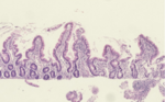 Thumbnail for Environmental enteropathy