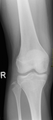 X-Ray of the knee