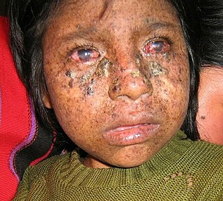 Xeroderma pigmentosum (XP) is a genetic disorder in which there 