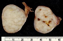 Adenomyosis - Wikipedia