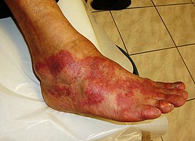 Allergy to Antibiotic Cefaclor.JPG