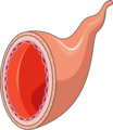 Atheroma 12