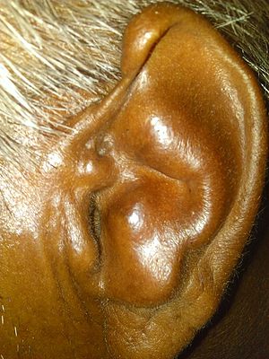 Cauliflower ear by dr vikram yadav.jpg