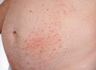 Dermatitis Herpetiforme 4.jpg