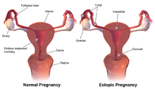 Implantation sites resulting in normal or ectopic pregnancies Ectopic Pregnancy.png