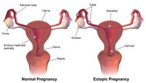 Ectopic Pregnancy.png