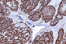 Micrograph of an angiosarcoma stained with a CD31 immunostain (dark brown). Epithelioid angiosarcoma - CD31 - intermed mag.jpg