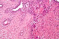 Micrograph of herpes esophagitis. H&E stain.