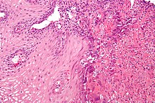 Microscopic Slide of Infectious Esophagitis Herpes esophagitis - high mag.jpg