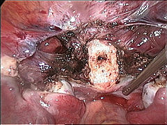 Cervical stump (white) after removal of the uterine corpus at laparoscopic supracervical hysterectomy