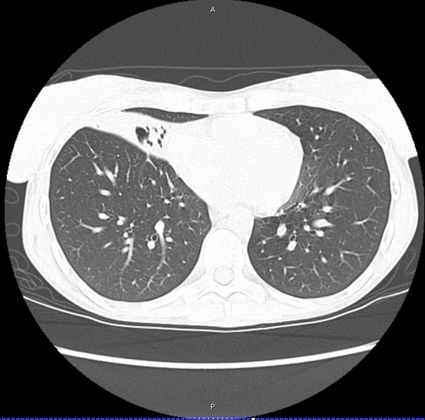 File:Lady windermere syndrome ct.JPG