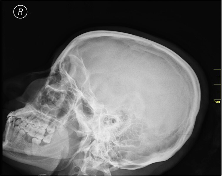 File:Medical X-Ray imaging OBP06 nevit.jpg