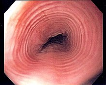 Endoscopic image of esophagus in a case of eosinophilic esophagitis. Concentric rings are termed trachealization of the esophagus. Multi ring esophagus.jpg