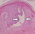 Nodular basal cell cancer with cleft.jpg