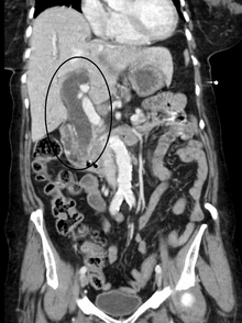 Biliary-tract dilation due to obstruction as seen on CT scan (frontal plane) Obstructivebiliarydilation.png