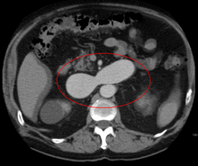 An arterial venous malformation of the left kidney leading to aneurysmal dilatation of the left renal vein and inferior vena cava PleftkidneyAVM2.png