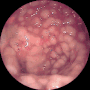 Miniatura para Colitis pseudomembranosa