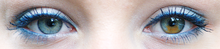 Sectoral heterochromia Sectoral heterochromia in left eye.png