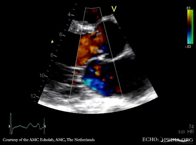 File:Severe aortic regurgitation E00182 (CardioNetworks ECHOpedia).webm