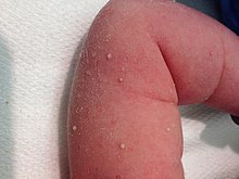 Гноячки в дитини з перехідним гноячковим меланозом новонароджених