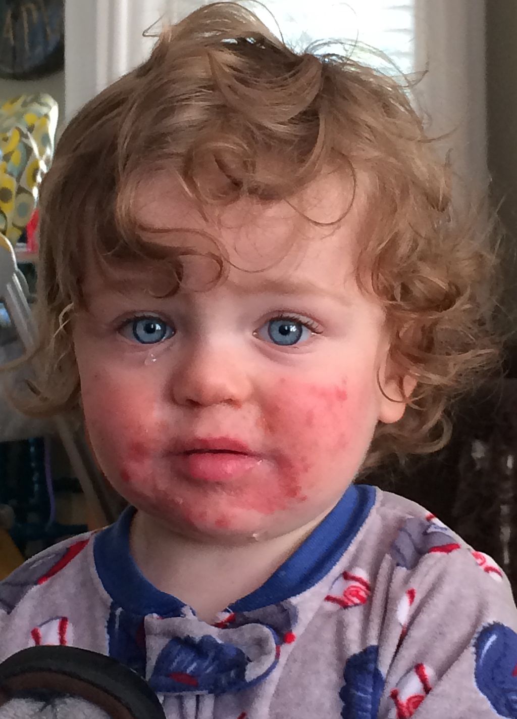 14 month old with Fifth Disease