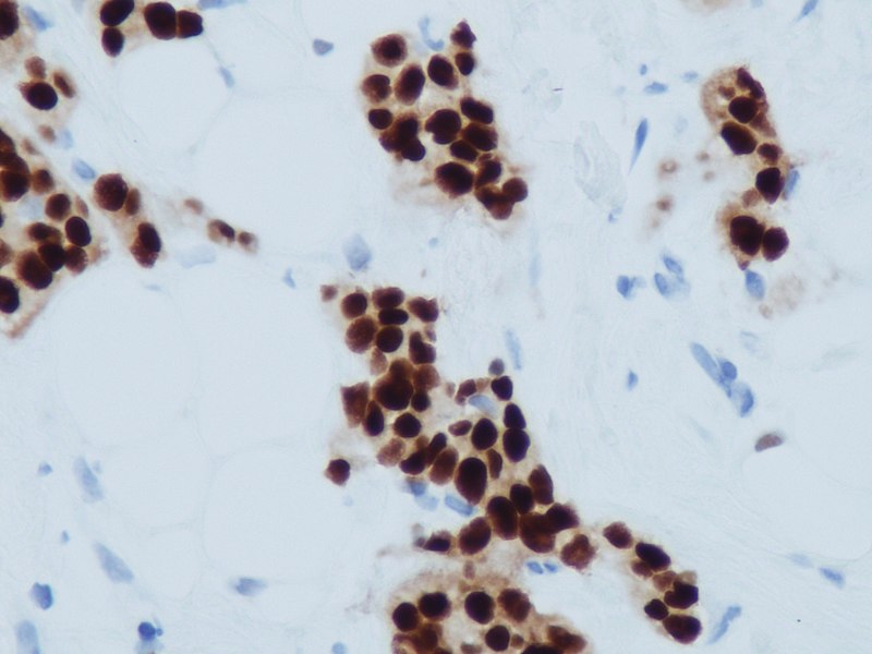 File:Carcinoma ductal infiltrante (receptores de estrógenos) (9301763058).jpg