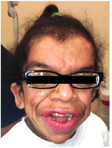 Costello syndrome facial manifestation 17-year-old female.png