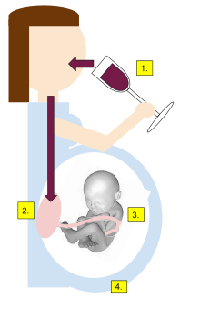 Fetal alcohol syndrome 1) Alcohol consumed (EtOH) 2) Alcohol crosses into the placenta 3) Alcohol metabolizes 4) Fatty acid ethyl esters (FAEE) detected in meconium Fetal Alcohol Syndrome.svg