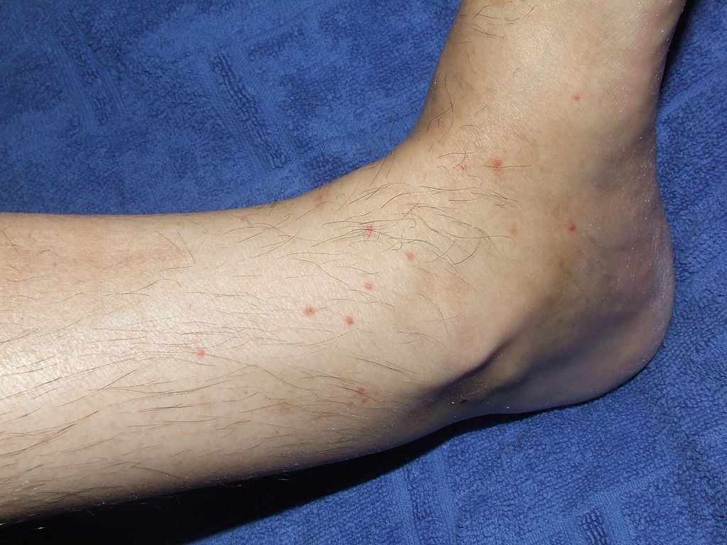 Flea Bites to the Lower Leg of a Human Subject 01