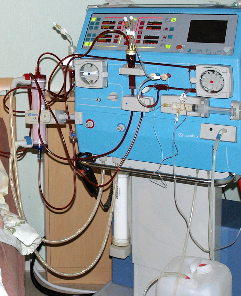 magas vérnyomás hemodialízis kezelése